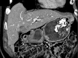 Recurrent Gallbladder Cancer - CTisus CT Scan