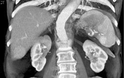 Hepatoma - CTisus CT Scan