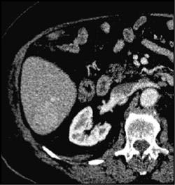 Hepatoma Barely Seen on Venous Phase - CTisus CT Scan