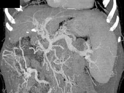 Cirrhosis With Varices - CTisus CT Scan