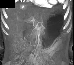 Hemangioma - CTisus CT Scan