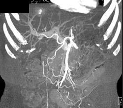 Hemangioma - CTisus CT Scan