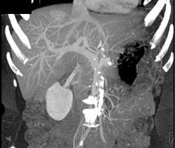 Hemangioma on Delayed Phase Images - CTisus CT Scan