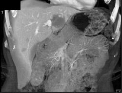 Hemangioma - CTisus CT Scan