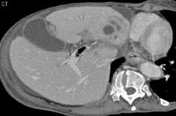 Air in Portal Vein With Liver Abscess - CTisus CT Scan