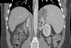 Cirrhosis With Varices - CTisus CT Scan