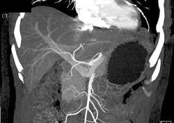 Normal Hepatic Artery - CTisus CT Scan