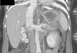 Varices Near Right Kidney - CTisus CT Scan