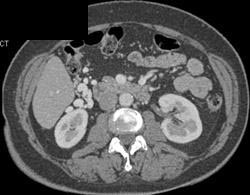 Cirrhosis With Varices - CTisus CT Scan