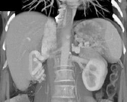 Cirrhosis With Varices - CTisus CT Scan