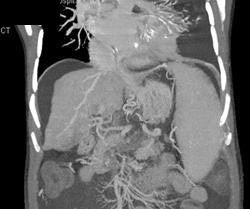 Cirrhosis With Varices - CTisus CT Scan