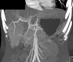 Cirrhosis - CTisus CT Scan