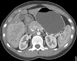 Hepatoma - CTisus CT Scan