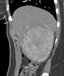 Hepatoma - CTisus CT Scan