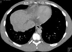 Hepatoma in A Cirrhotic Liver - CTisus CT Scan