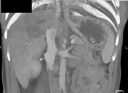 Cirrhosis With Hepatoma Invading the IVC - CTisus CT Scan