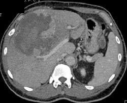 Bleed Within A Hepatoma - CTisus CT Scan