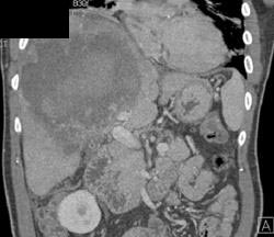 Intrahepatic Bleed - CTisus CT Scan