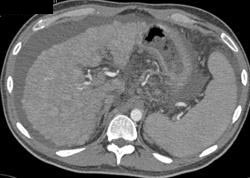 Cirrhosis With Ascites - CTisus CT Scan