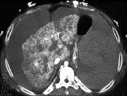 Cirrhosis - CTisus CT Scan