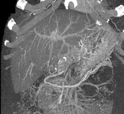 Fatty Liver - CTisus CT Scan