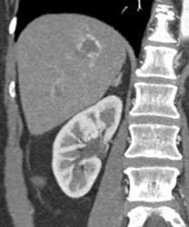 Hemangioma - CTisus CT Scan