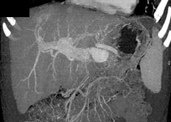 Hemangioma - CTisus CT Scan