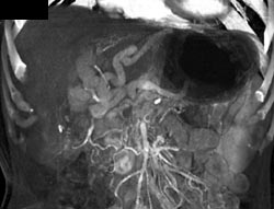 Cavernous Transformation of the Portal Vein - CTisus CT Scan