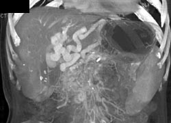 Cavernous Transformation of the Portal Vein - CTisus CT Scan