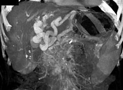 Cavernous Transformation of the Portal Vein - CTisus CT Scan