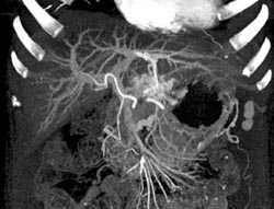 Giant Hemangioma - CTisus CT Scan