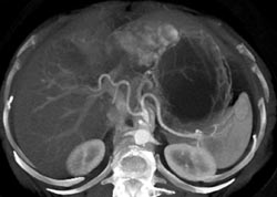 Giant Hemangioma - CTisus CT Scan