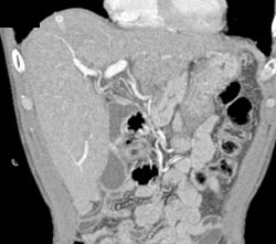 Hemangioma - CTisus CT Scan