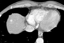 Hemangioma - CTisus CT Scan