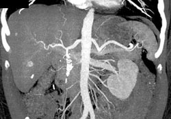 Carcinoid Metastases - CTisus CT Scan