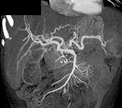 Cirrhosis - CTisus CT Scan