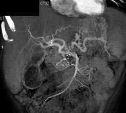 Cirrhosis - CTisus CT Scan