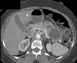 1 Cm Presumed Hepatoma in Cirrhotic Liver - CTisus CT Scan