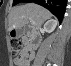 Possible Hepatoma - CTisus CT Scan