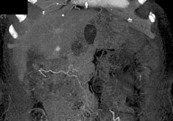 Presumed Hepatoma - CTisus CT Scan