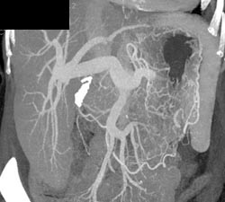 Cirrhosis With Prominent Portal Vein - CTisus CT Scan