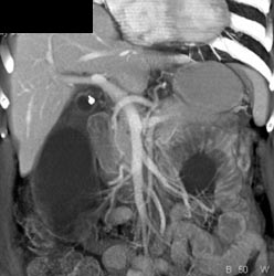 Dilated Gallbladder With Impacted Stone in the Neck of the Gallbladder - CTisus CT Scan