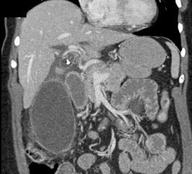 Impacted Stone in the Neck of the Gallbladder - CTisus CT Scan