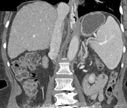 Esophageal Varices With Cirrhosis - CTisus CT Scan