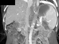 Esophageal Varices and Cirrhosis - CTisus CT Scan