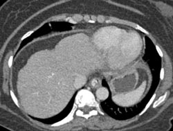 Cirrhosis - CTisus CT Scan