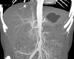 Hepatoma - CTisus CT Scan