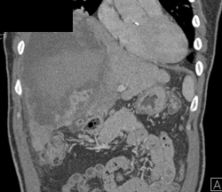 Hemorrage in A Hepatoma - CTisus CT Scan