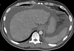 Cirrhosis With Nodularity - CTisus CT Scan