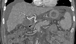 Cirrhosis - CTisus CT Scan